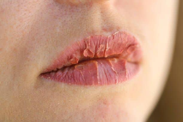 Đôi môi cần 5 - 7 ngày để bong da sau khi xăm