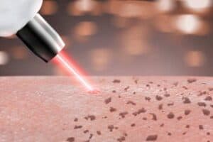 Chăm sóc da sau laser trị nám như nào là khoa học?