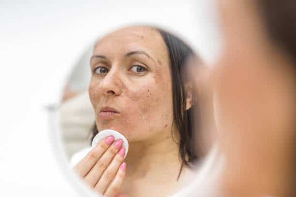 Cách chăm sóc da mặt bị nám